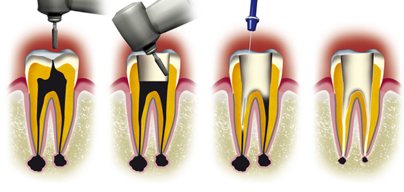 Traitement du canal dentaire
